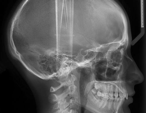 рентген черепа